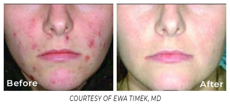 Before and After laser treatment for acne