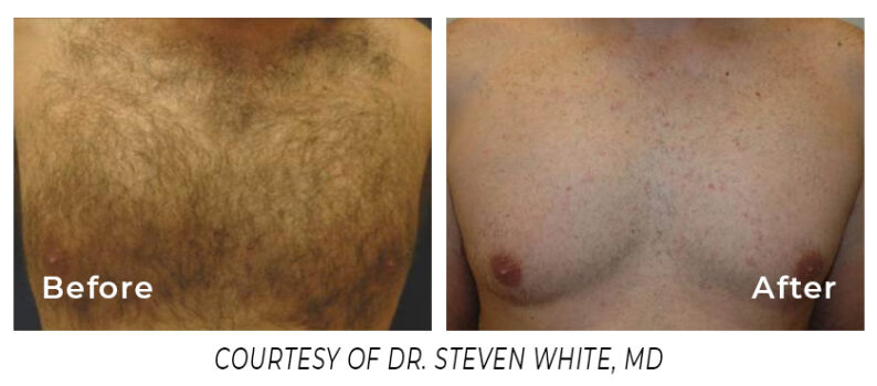 Before and After hair on a man's chest