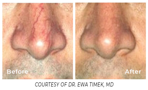 Before and After veins on a man's nose