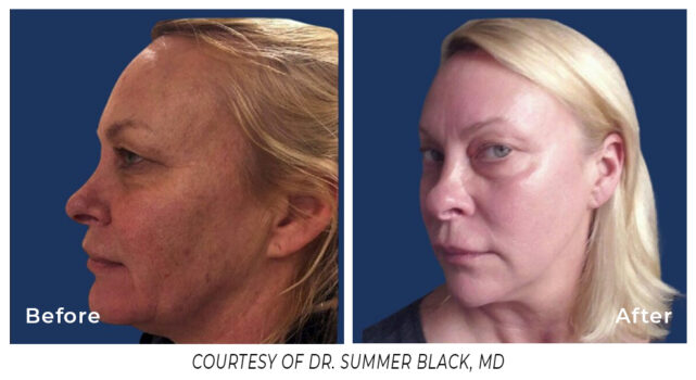 Before and After laser treatment on a woman's face