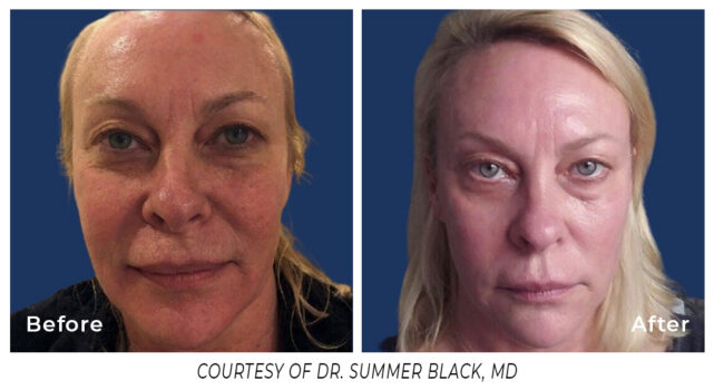 Before and After laser treatment on a woman's face