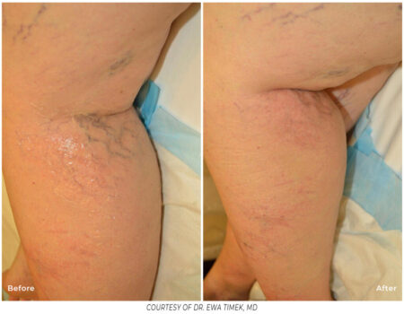 Before and After leg veins