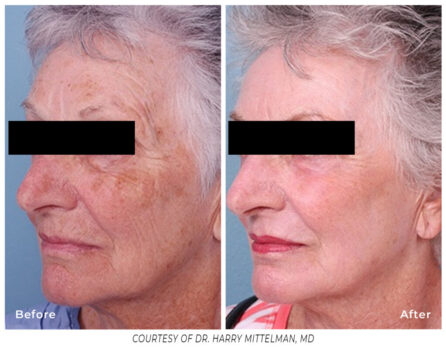 Before and After wrinkles